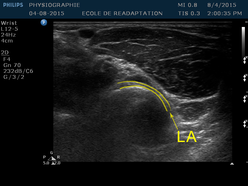 : Ligament annulaire
